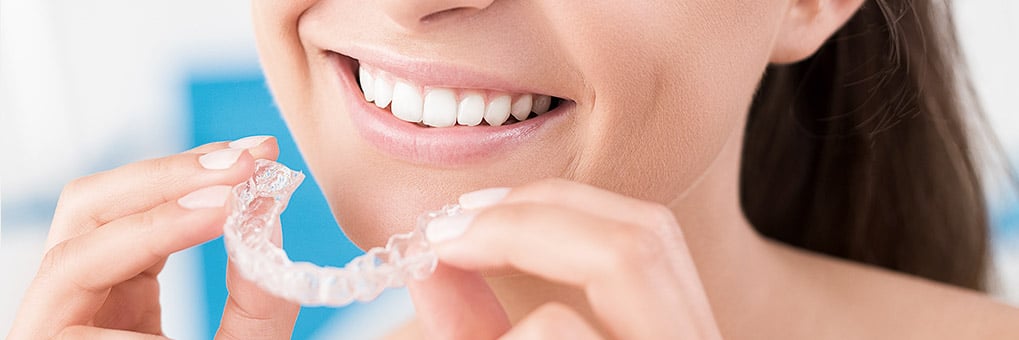 Smile makeover Invisalign