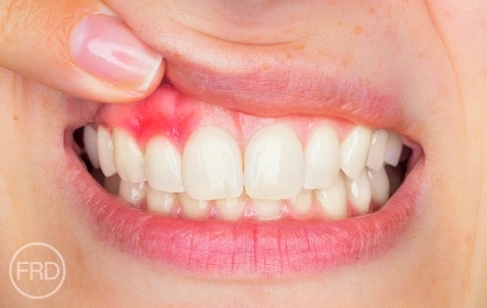 dental bonding for receding gums