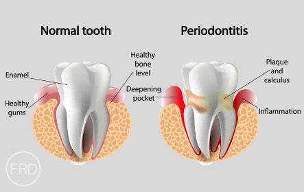Gum Disease