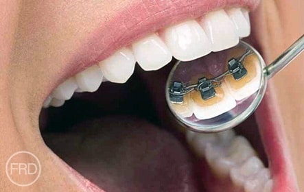 Invisalign dentist