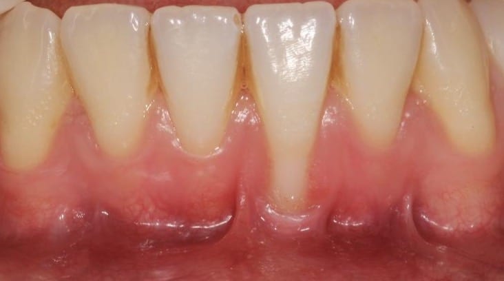 Treating Gingival Recession At Fulham Road Dental Fulham Road Dental