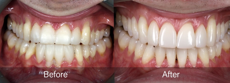 George the Dentist Composite Bonding