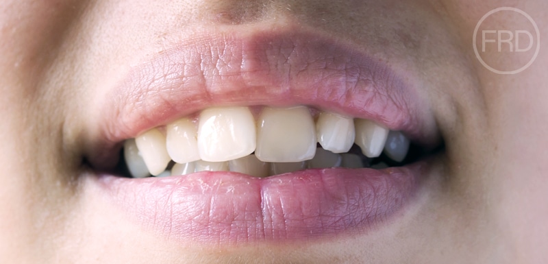 Invisalign Treatment