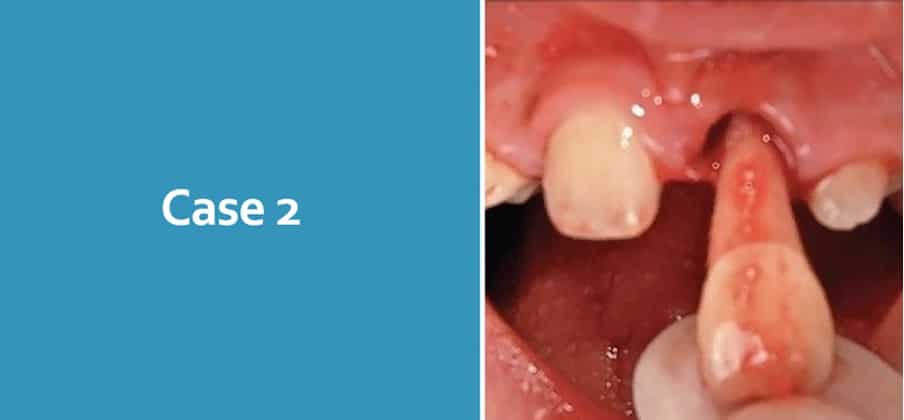Luxation Case 2