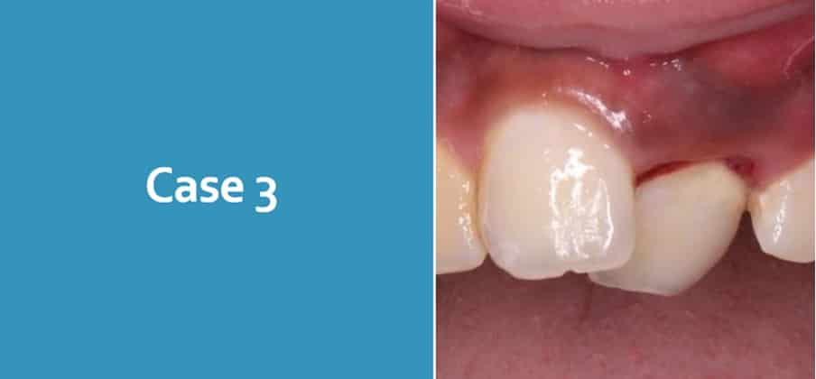 Luxation Case 3