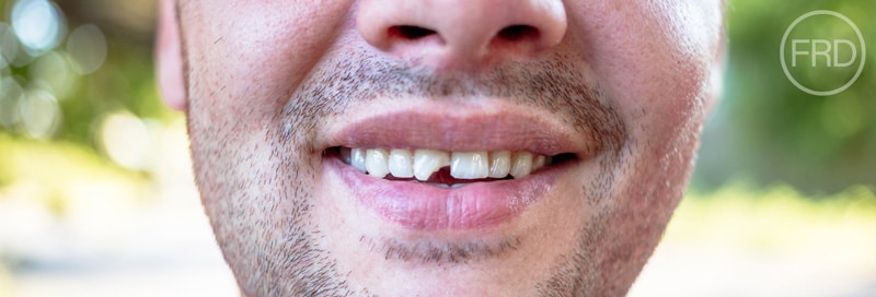 Chipped Teeth Tooth Restoration