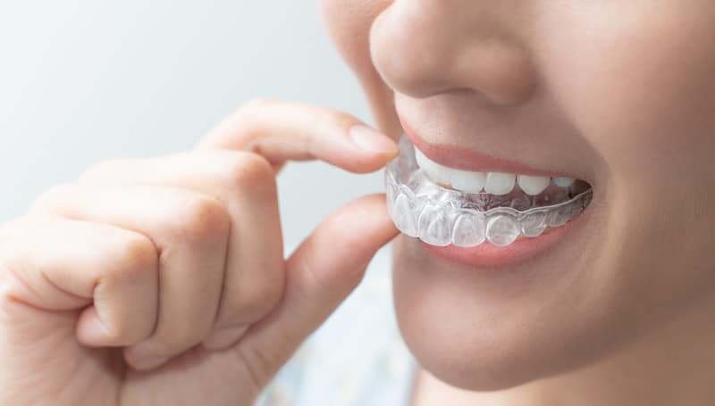 Orthodontistic Treatment - Fulham Road Dental