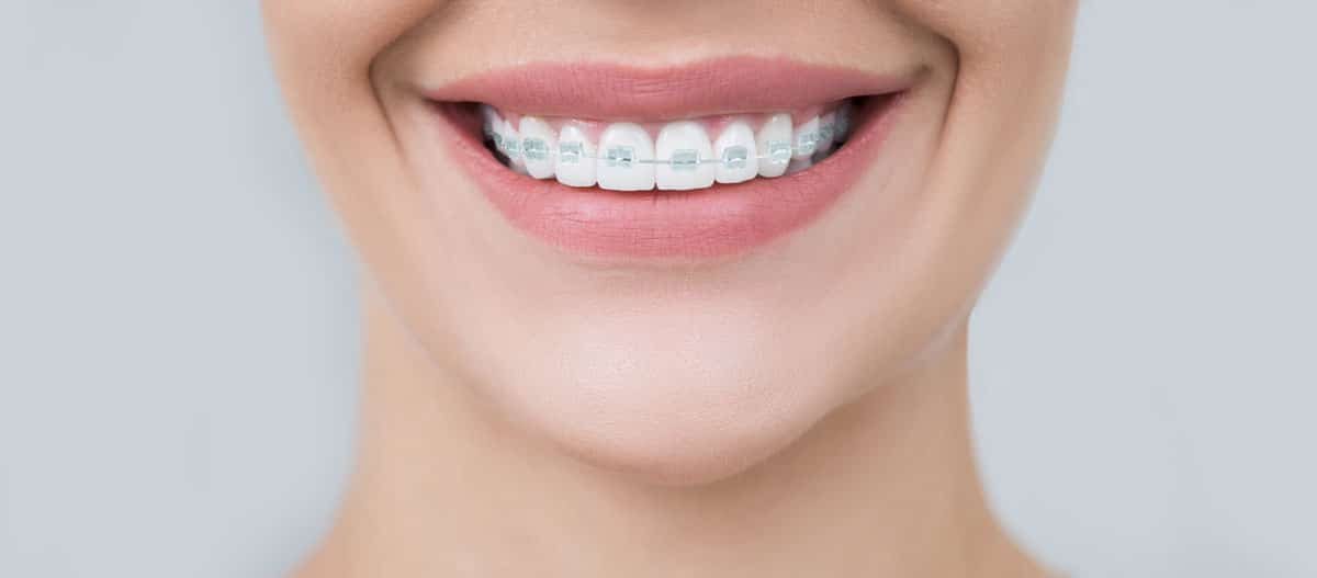 Fulham Road Dental - Teeth Straightening 