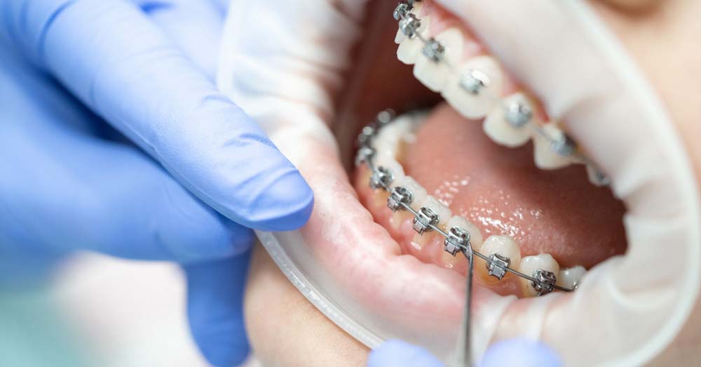 Long-Term Stability: How Long Does It Take to Straighten Teeth?
