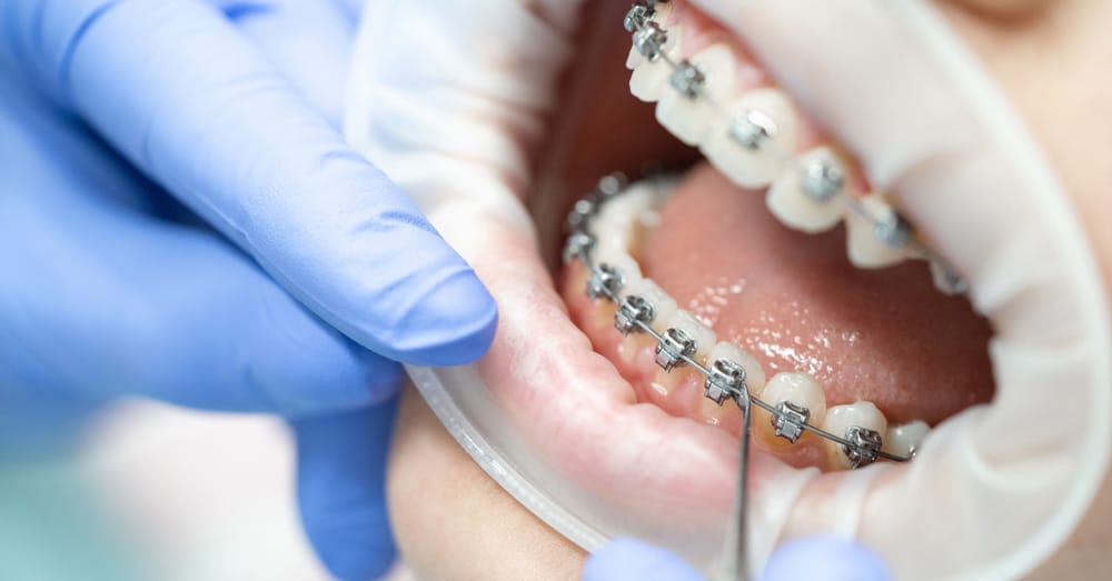 Orthodontic Braces - Fulham Road Dental