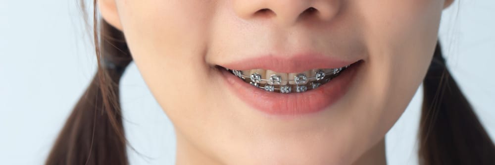 Long-Term Stability: How Long Does It Take to Straighten Teeth? - Direct Dental Wandsworth