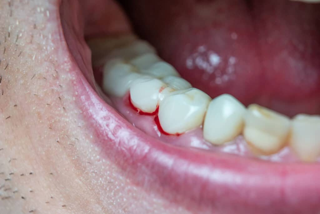 Gum disease Warning signs and symptoms