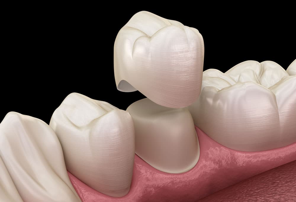 Restoring tooth functionality