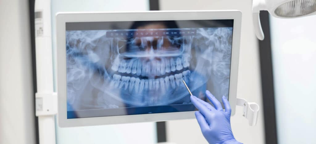 Tooth decay treatment