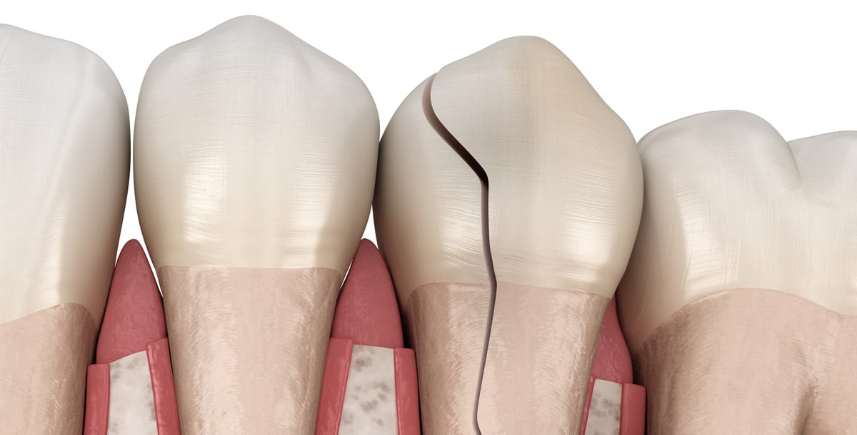 What causes cracks in teeth