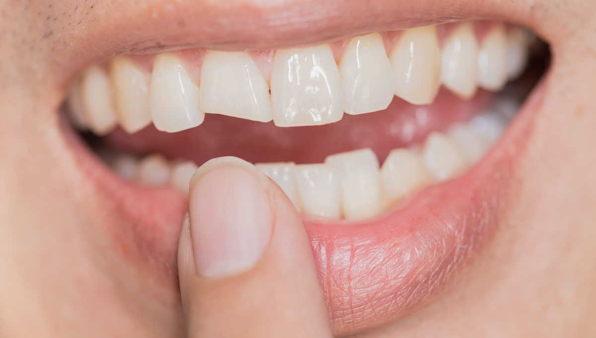 Can broken teeth look natural again