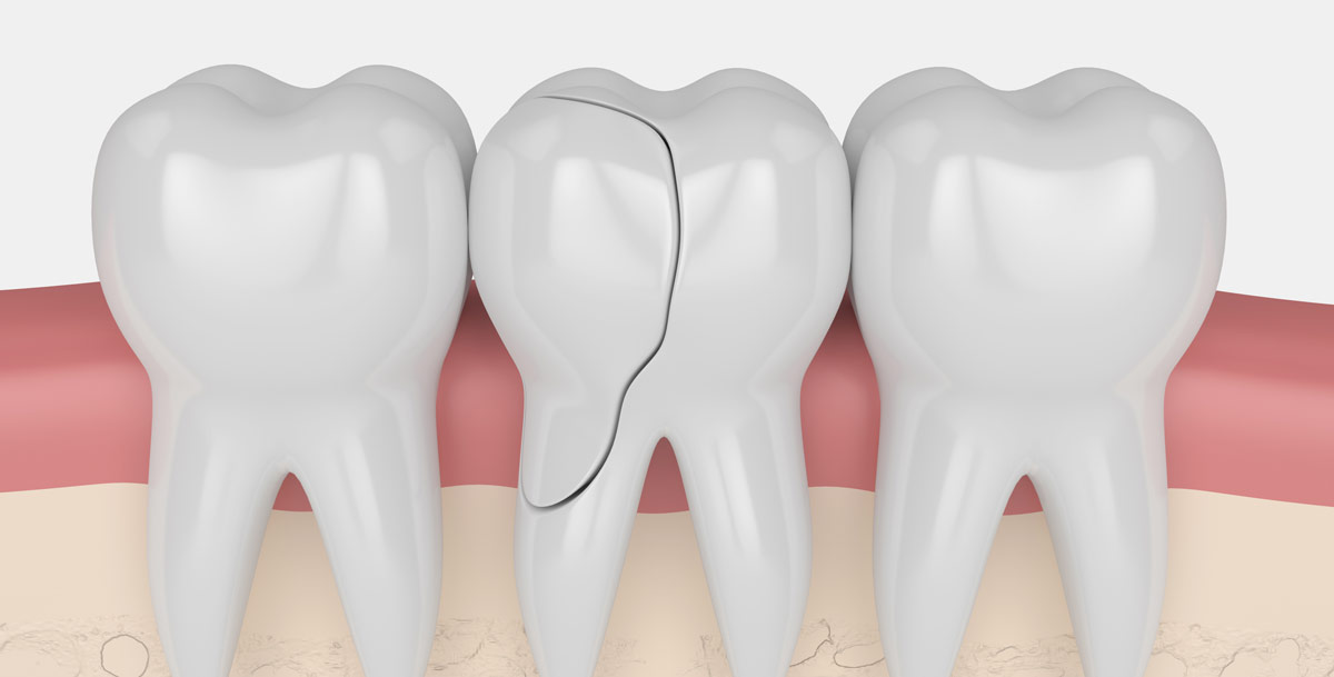 Common causes of broken teeth