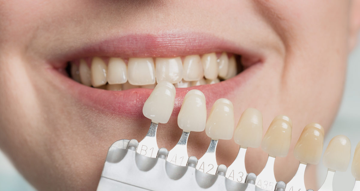 Treatment options for broken teeth