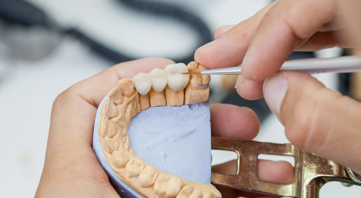 Types of dental bridges