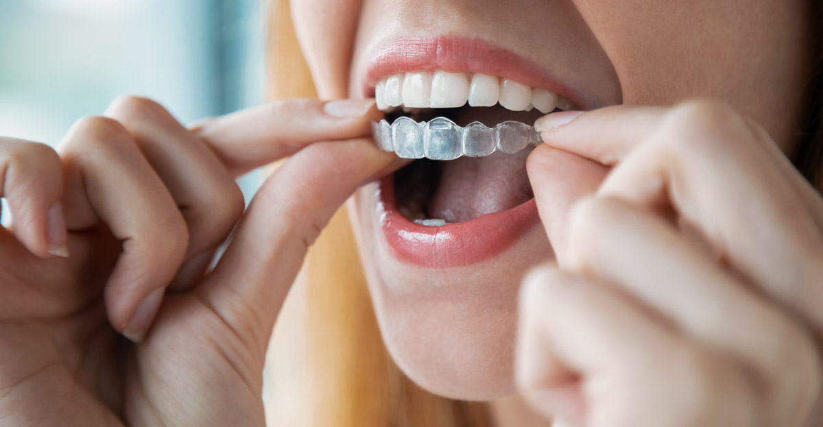 Wear retainers as directed
