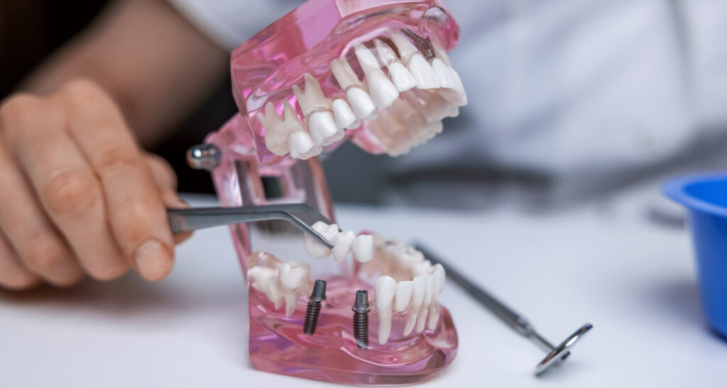 bridge for the teeth