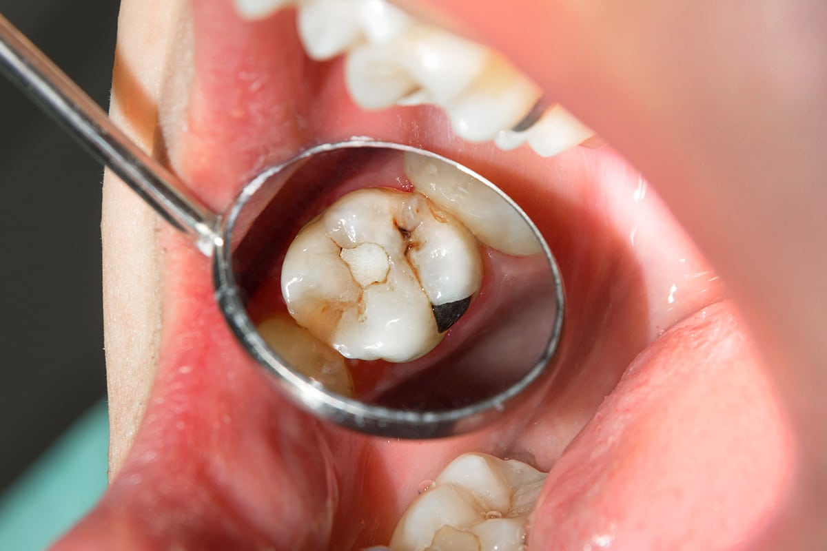 tooth is black decay