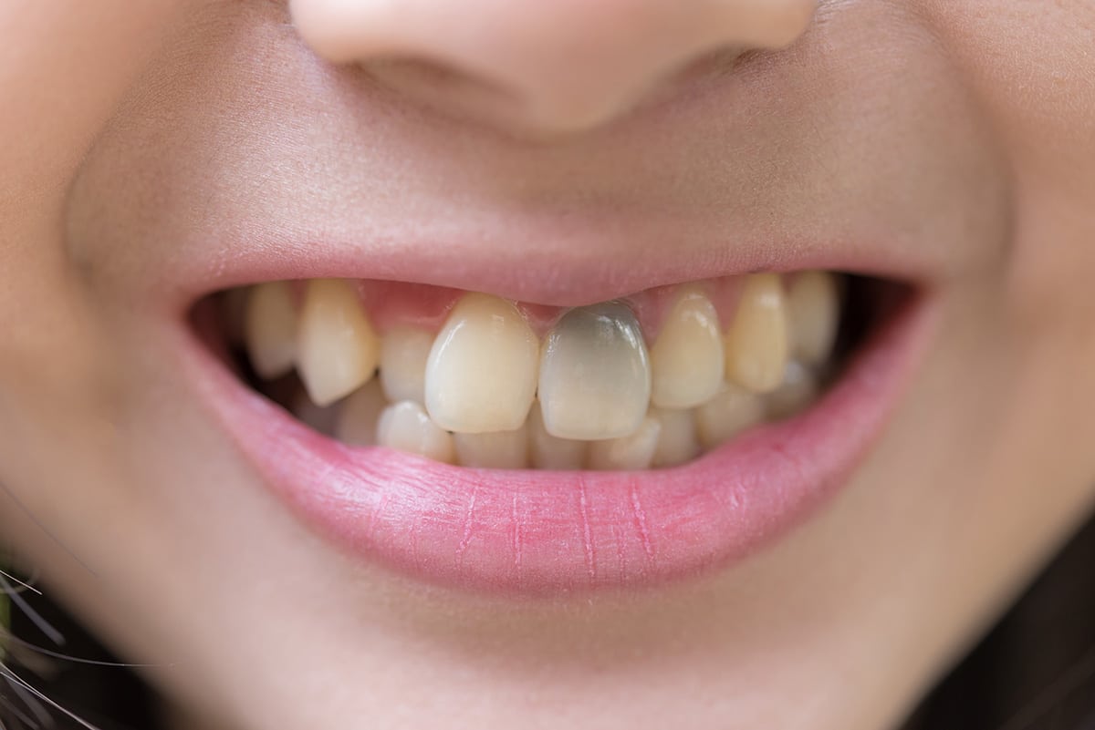 tooth is black fulham road dentist