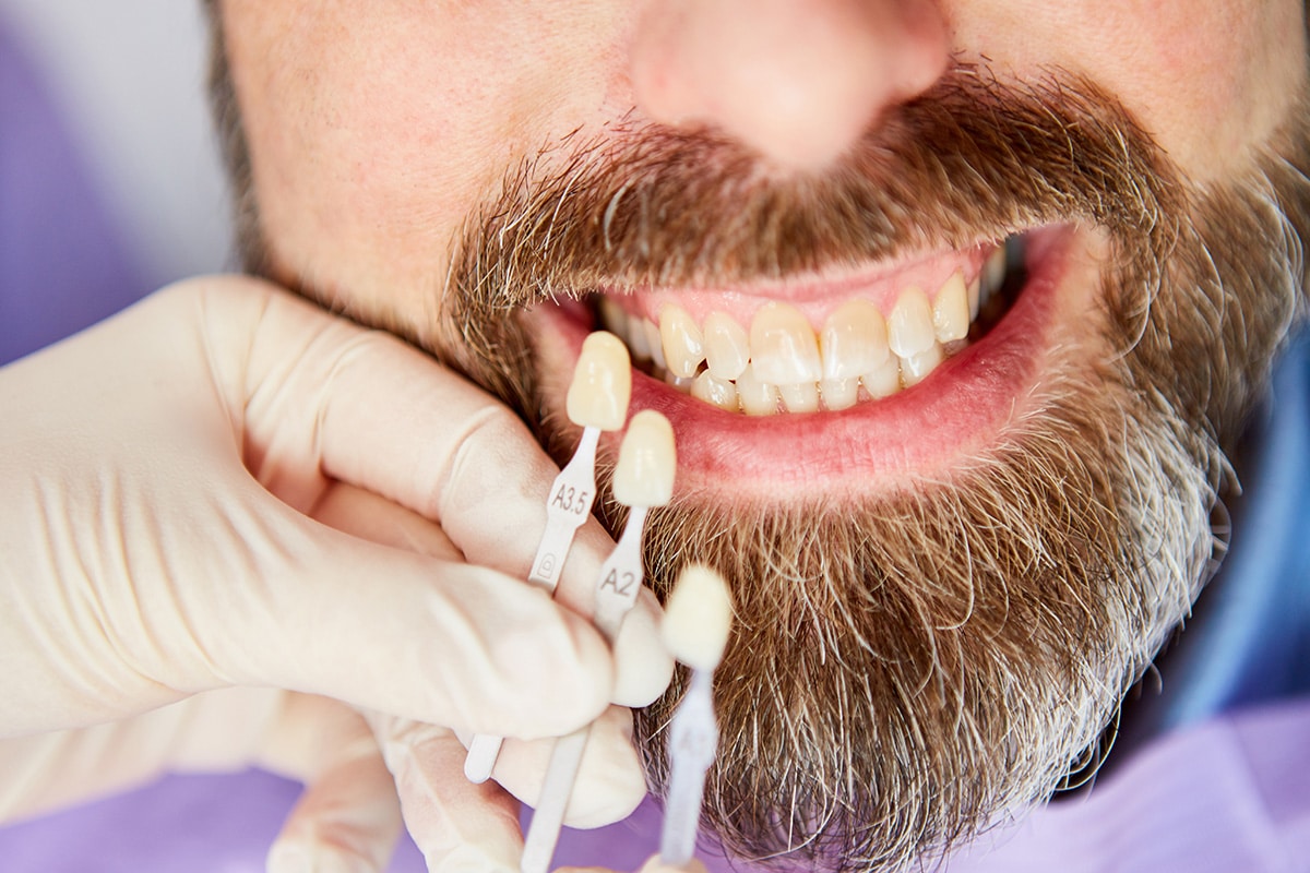 tooth is black staining fulham road dentist