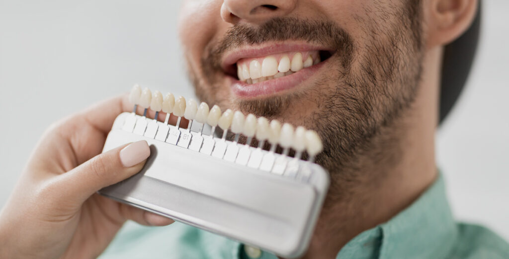 composite veneers