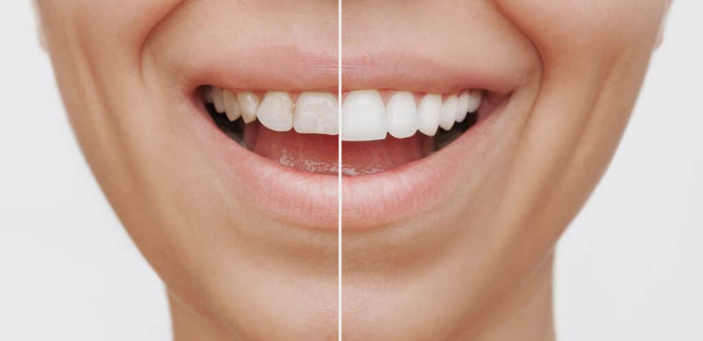 woman teeth difference with how composite veneers work
