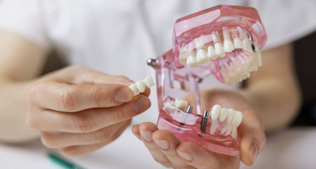 artificial teeth options dental bridge model
