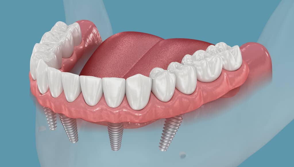 artificial teeth options implant supported dentures