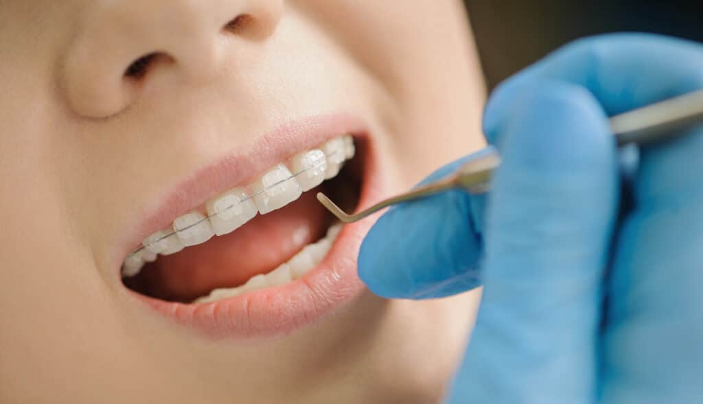 dentists ceramic braces straighten teeth as an adult