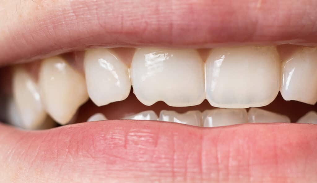 chipped tooth. emergency dental