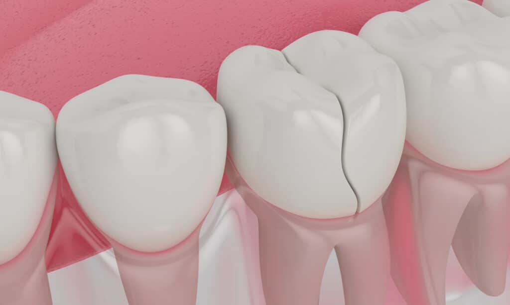 cracked tooth diagram reasons for getting crowns for teeth