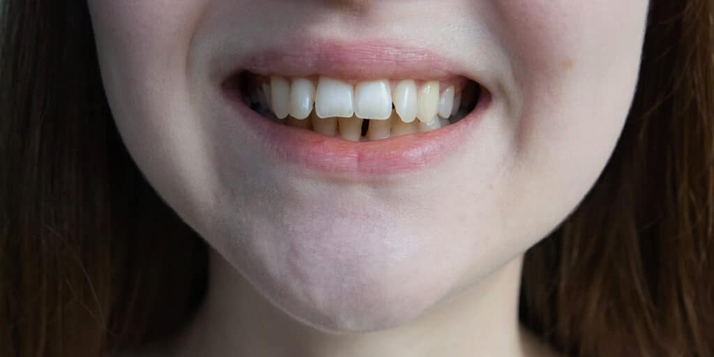 Woman with overbite on teeth what can invisalign not fix