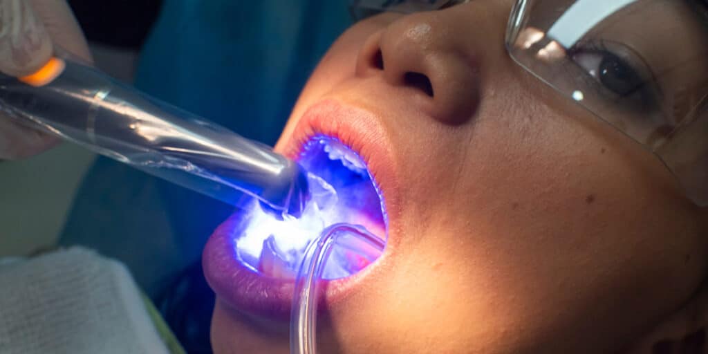 woman at dentists for composite bonding front teeth