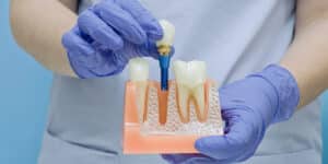 dental implants in london