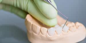 dental implants vs bridges