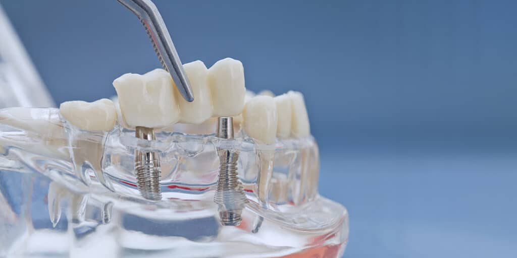 tweesers holding dental bridge and dental implants vs bridges