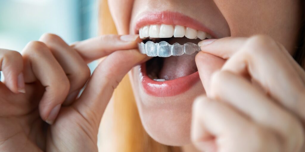 Patient fitting clear aligners and Invisalign cost London