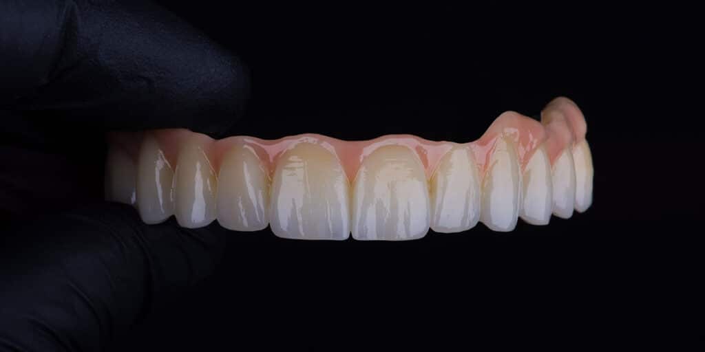 gloved hand holding full mouth dental implants