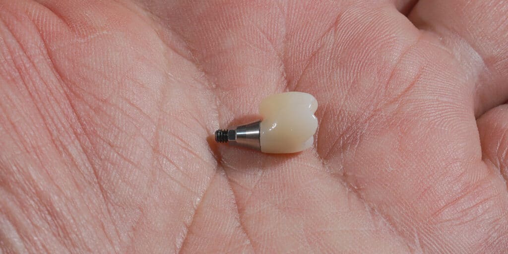 single tooth implant