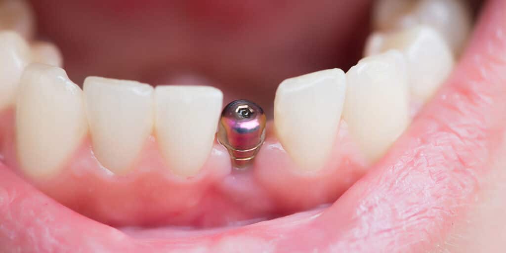 single tooth implant in persons mouth